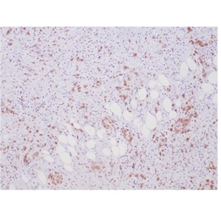Immunohistochemistry - Anti-ALK Antibody [ALK1/7008R] (A277986) - Antibodies.com