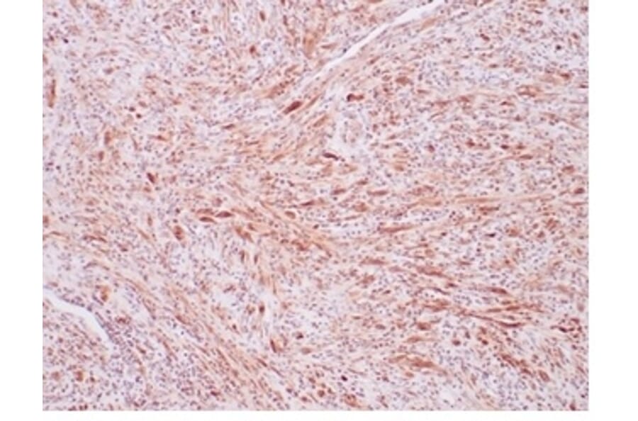 Immunohistochemistry - Anti-ALK Antibody [ALK1/7008R] (A277986) - Antibodies.com