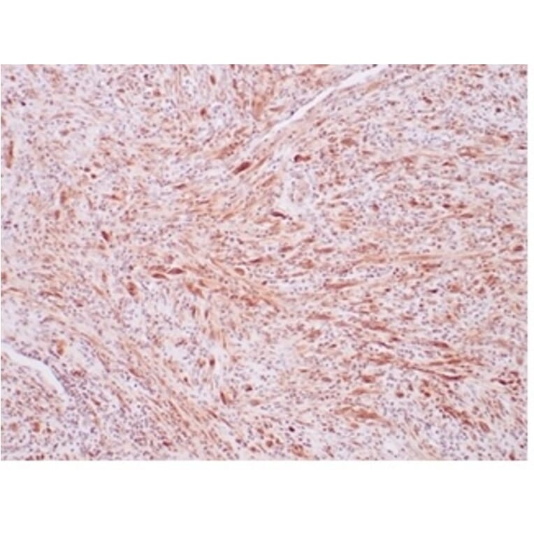 Immunohistochemistry - Anti-ALK Antibody [ALK1/7008R] (A277986) - Antibodies.com