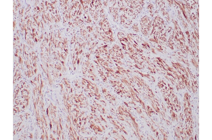 Immunohistochemistry - Anti-ALK Antibody [ALK1/6698R] (A277987) - Antibodies.com