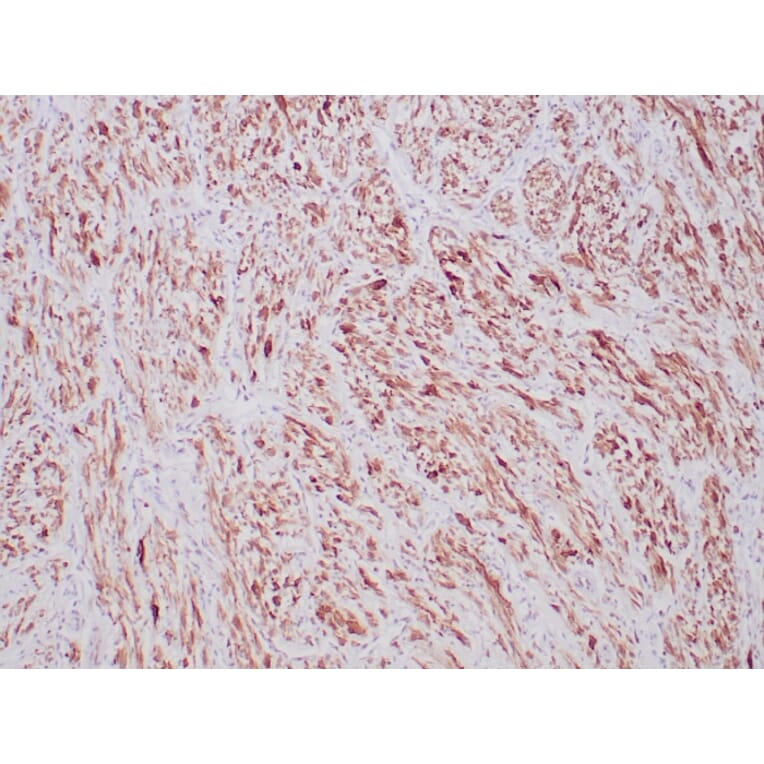 Immunohistochemistry - Anti-ALK Antibody [ALK1/6698R] (A277987) - Antibodies.com