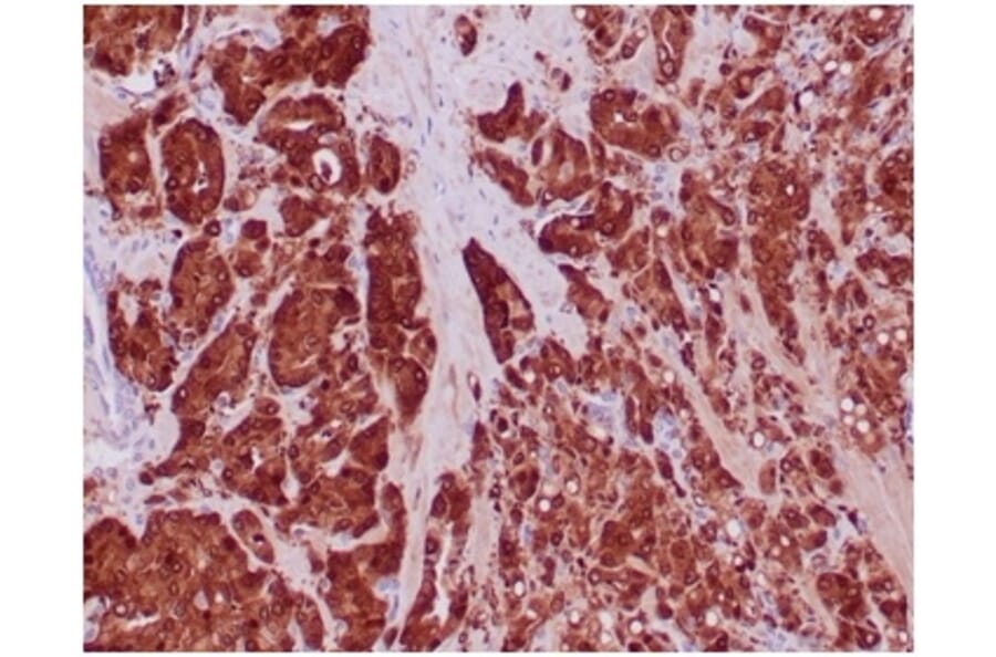 Immunohistochemistry - Anti-IDH1 (mutated R132H) Antibody [IDH1/6806R] (A277999) - Antibodies.com