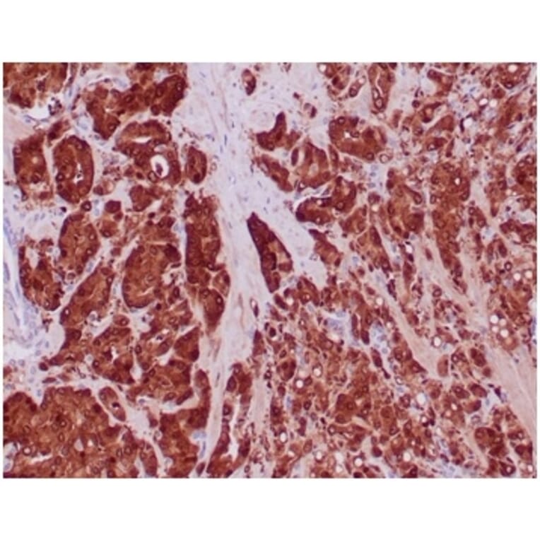 Immunohistochemistry - Anti-IDH1 (mutated R132H) Antibody [IDH1/6806R] (A277999) - Antibodies.com
