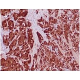 Immunohistochemistry - Anti-IDH1 (mutated R132H) Antibody [IDH1/6806R] (A277999) - Antibodies.com