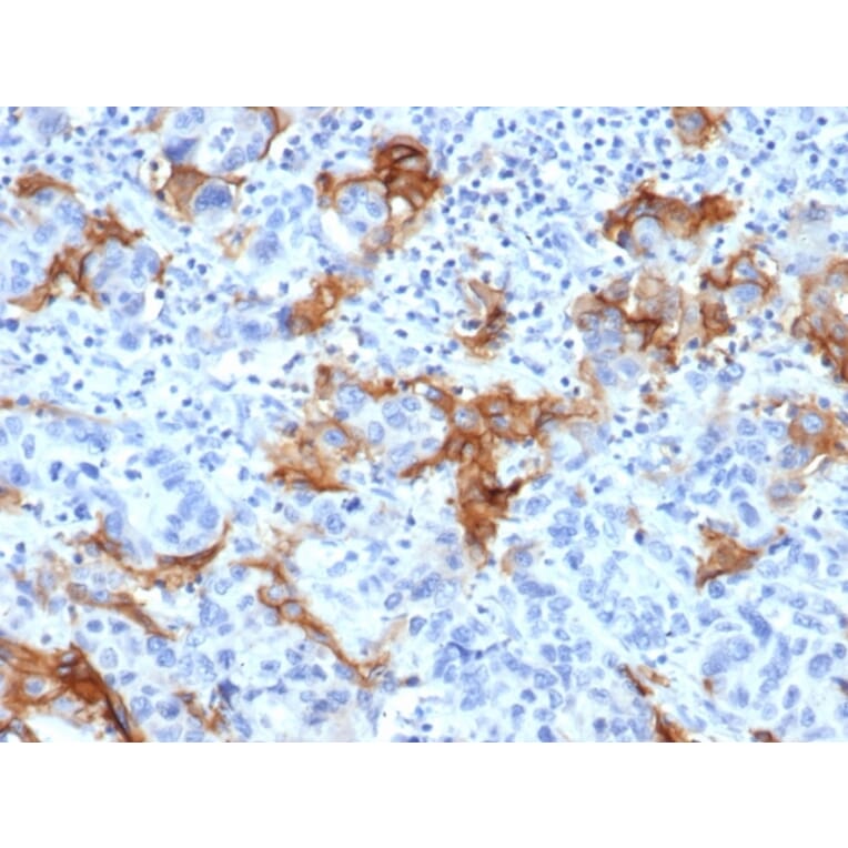 Immunohistochemistry - Anti-TROP2 Antibody [TACSTD2/6394R] (A278023) - Antibodies.com