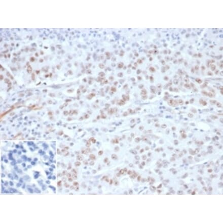 Immunohistochemistry - Anti-MLH1 Antibody [MLH1/6284R] (A278029) - Antibodies.com