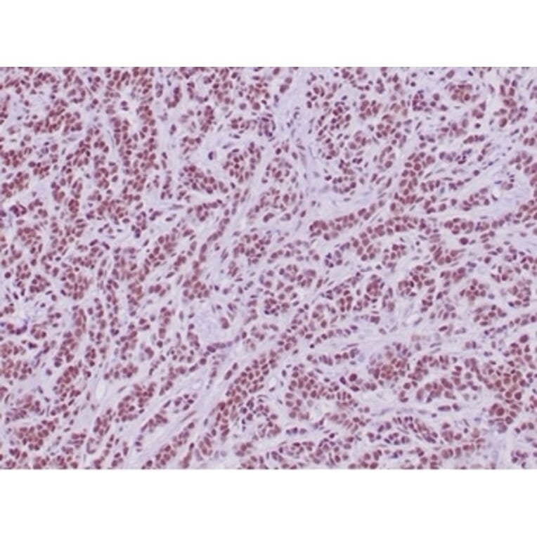 Immunohistochemistry - Anti-SNF5 Antibody [SMARCB1/4587R] (A278064) - Antibodies.com