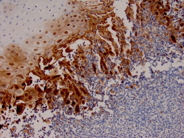 Immunohistochemical analysis of formalin-fixed, paraffin-embedded human esophageal carcinoma tissue using Anti-HSV1 Antibody [HSV1/4055R].