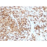 Immunohistochemistry - Anti-Melanoma gp100 Antibody [rPMEL17/6821] - BSA and Azide free (A278506) - Antibodies.com