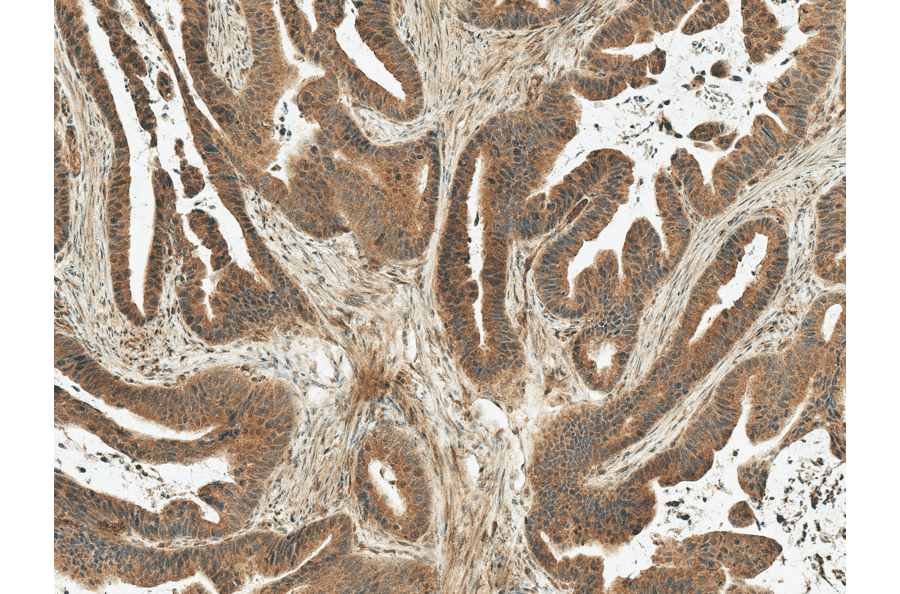 Immunohistochemistry - Anti-MDM2 Antibody (A305002) - Antibodies.com