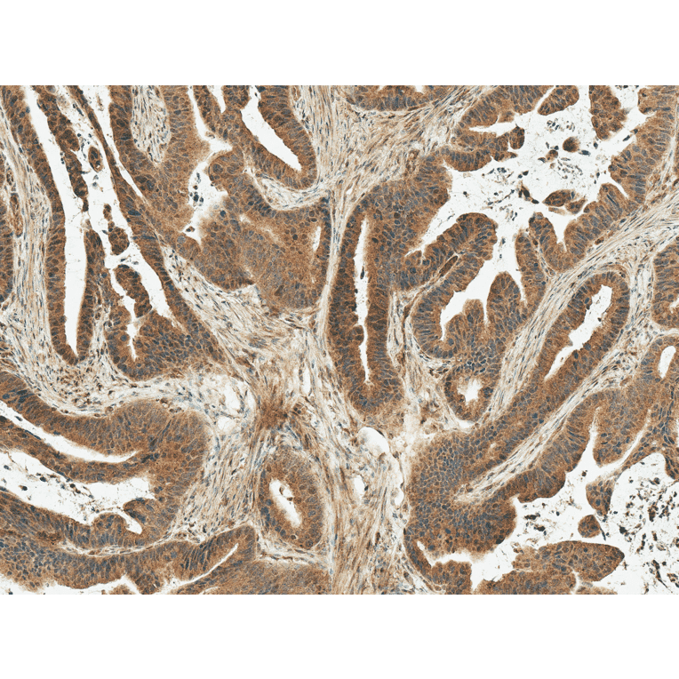 Immunohistochemistry - Anti-MDM2 Antibody (A305002) - Antibodies.com