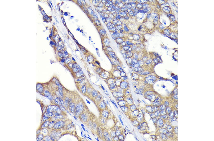 Immunohistochemistry - Anti-Fatty Acid Synthase Antibody [ARC0377] (A305468) - Antibodies.com
