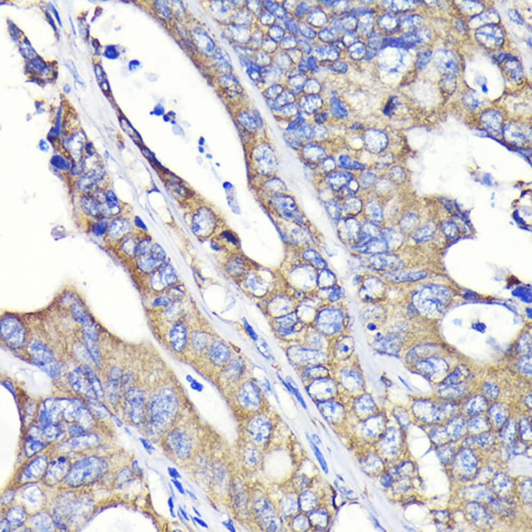Immunohistochemistry - Anti-Fatty Acid Synthase Antibody [ARC0377] (A305468) - Antibodies.com