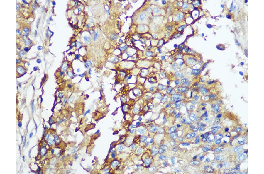 Immunohistochemistry - Anti-Carbonic Anhydrase 9/CA9 Antibody [ARC1275] (A306242) - Antibodies.com