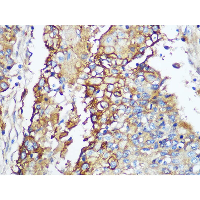 Immunohistochemistry - Anti-Carbonic Anhydrase 9/CA9 Antibody [ARC1275] (A306242) - Antibodies.com