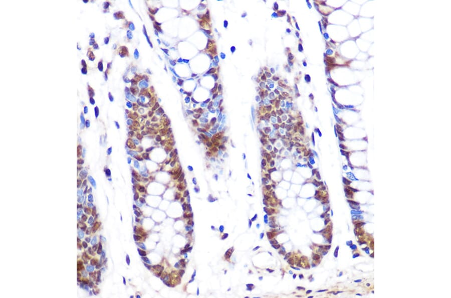 Immunohistochemistry - Anti-PFKFB3 Antibody (A306538) - Antibodies.com