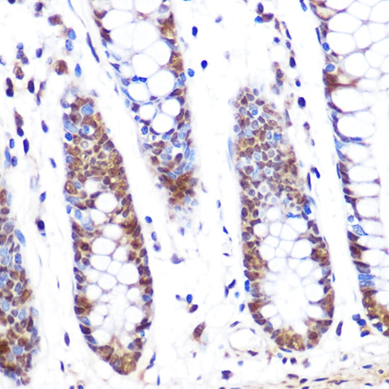 Immunohistochemistry - Anti-PFKFB3 Antibody (A306538) - Antibodies.com