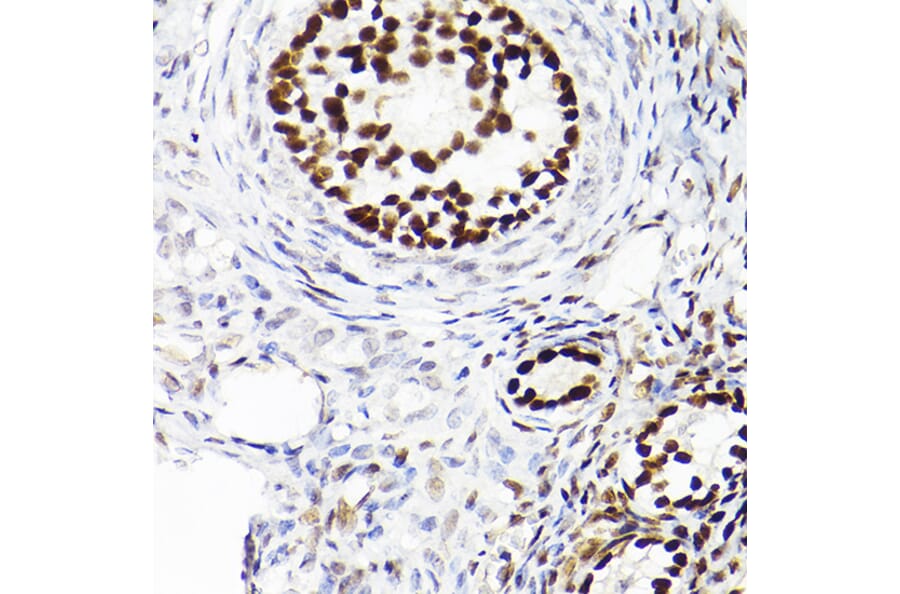 Immunohistochemistry - Anti-Wilms Tumor Protein Antibody [ARC2610] (A308215) - Antibodies.com