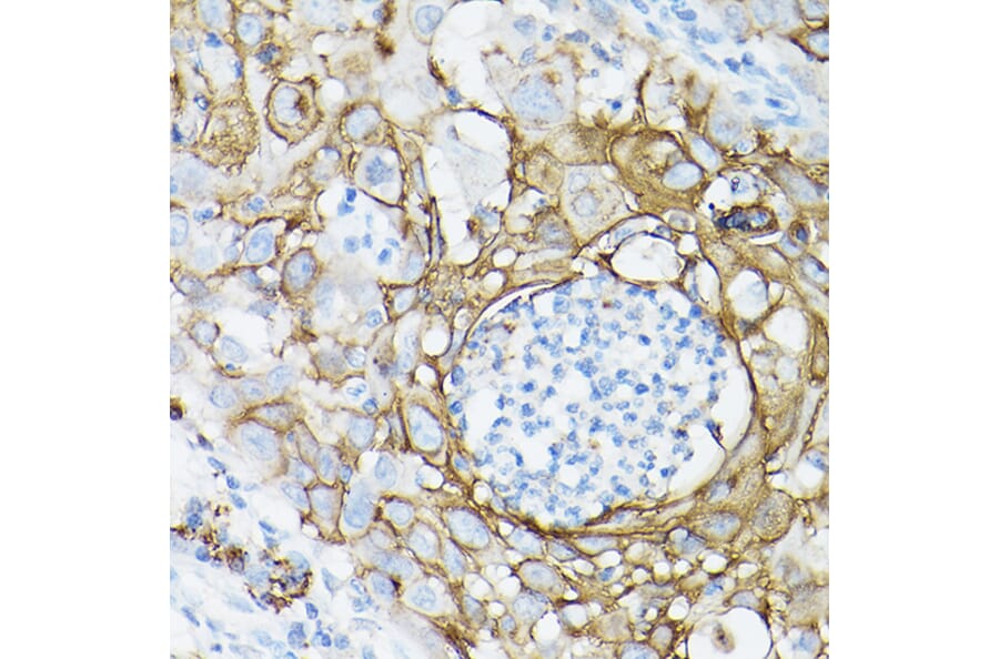 Immunohistochemistry - Anti-MUC1 Antibody [ARC0352] (A309097) - Antibodies.com