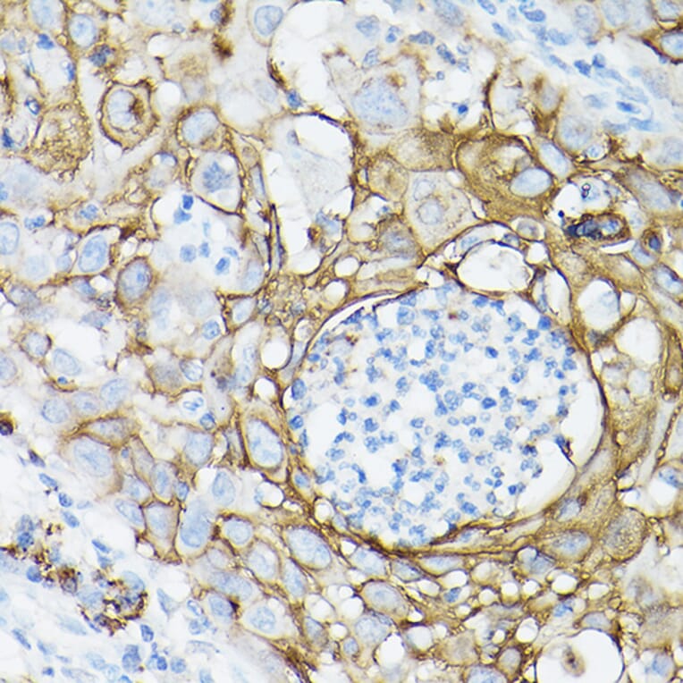 Immunohistochemistry - Anti-MUC1 Antibody [ARC0352] (A309097) - Antibodies.com