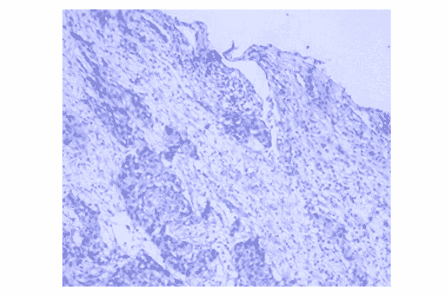 Immunohistochemistry - Anti-Lung Carcinoma Antibody (MO-T40005C) - Antibodies.com