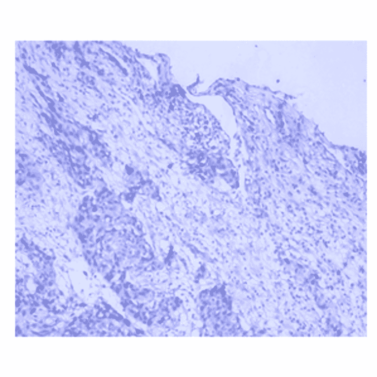 Immunohistochemistry - Anti-Lung Carcinoma Antibody (MO-T40005C) - Antibodies.com