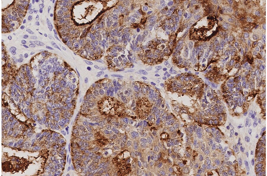 Immunohistochemistry - Anti-MUC16 Antibody [Ov185:1] (A320601) - Antibodies.com