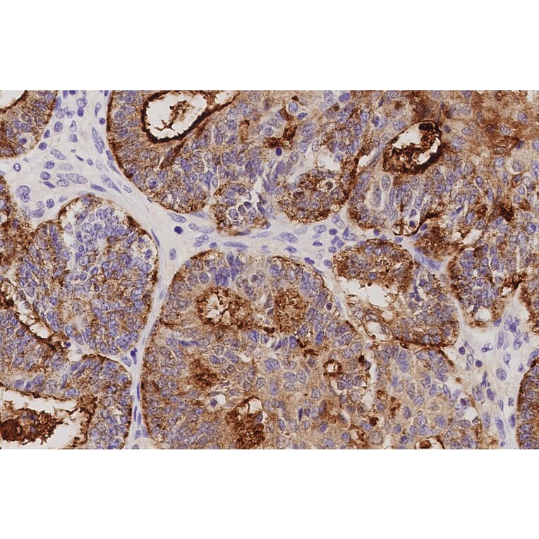 Immunohistochemistry - Anti-MUC16 Antibody [Ov185:1] (A320601) - Antibodies.com