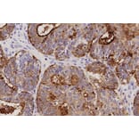 Immunohistochemistry - Anti-MUC16 Antibody [Ov185:1] (A320601) - Antibodies.com