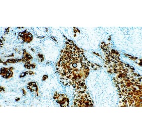 Immunohistochemistry - Anti-pan Cytokeratin Antibody [5D3 + LP34] (A320631) - Antibodies.com