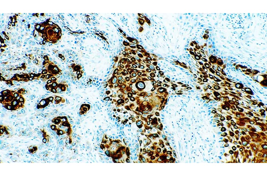 Immunohistochemistry - Anti-pan Cytokeratin Antibody [5D3 + LP34] (A320631) - Antibodies.com