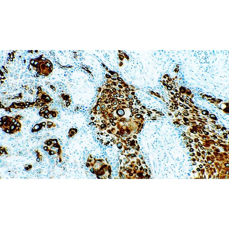 Immunohistochemistry - Anti-pan Cytokeratin Antibody [5D3 + LP34] (A320631) - Antibodies.com