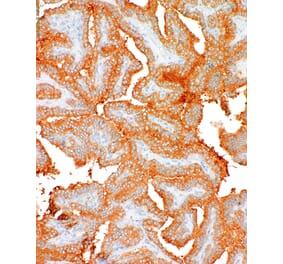 Immunohistochemistry - Anti-BRAF (mutated V600E) Antibody [IHC600] (A324400) - Antibodies.com