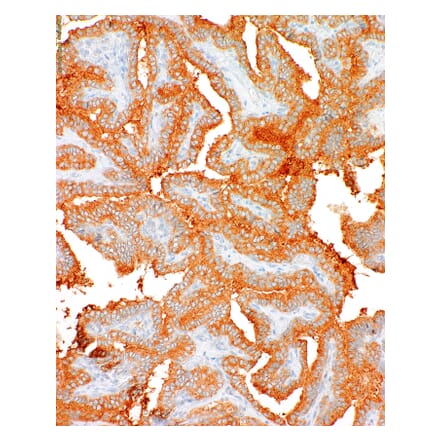 Immunohistochemistry - Anti-BRAF (mutated V600E) Antibody [IHC600] (A324400) - Antibodies.com