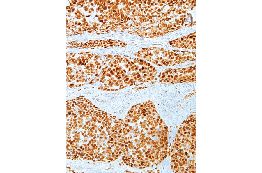 Immunohistochemistry - Anti-MDM2 Antibody [IHC620] (A324403) - Antibodies.com