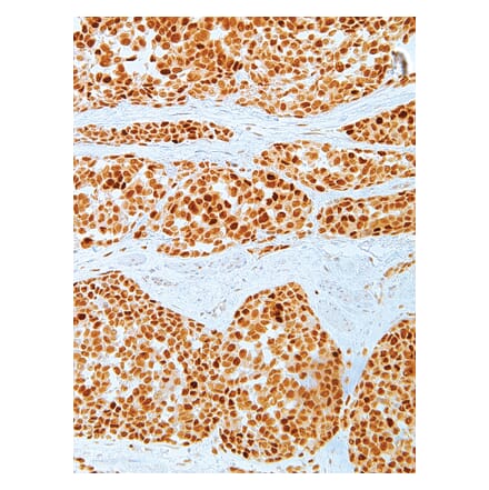 Immunohistochemistry - Anti-MDM2 Antibody [IHC620] (A324403) - Antibodies.com