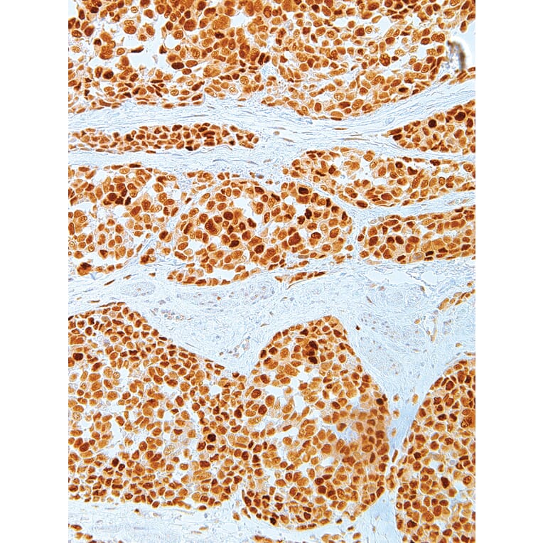 Immunohistochemistry - Anti-MDM2 Antibody [IHC620] (A324403) - Antibodies.com