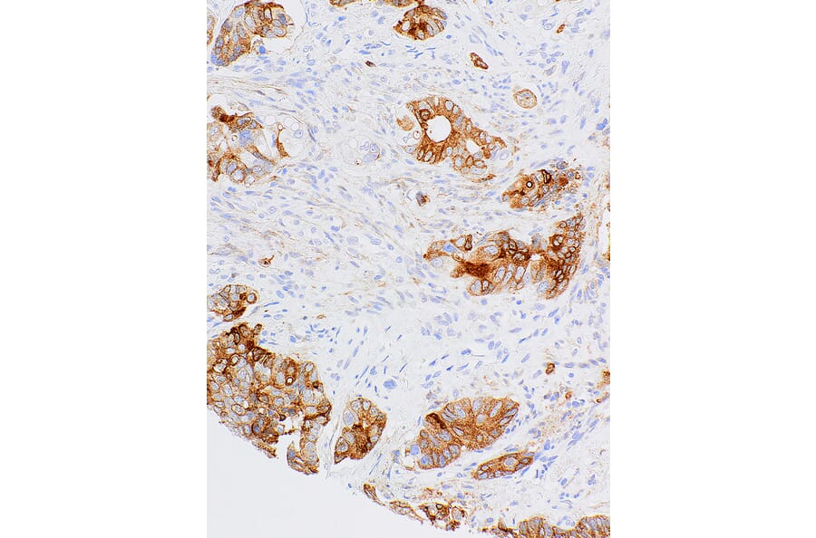 Immunohistochemistry - Anti-MUC1 Antibody [IHC566] (A324421) - Antibodies.com