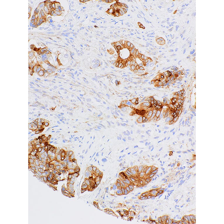 Immunohistochemistry - Anti-MUC1 Antibody [IHC566] (A324421) - Antibodies.com