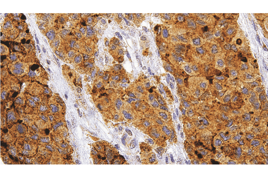 Immunohistochemistry - Anti-Glypican 3 Antibody [IHC305] (A324466) - Antibodies.com