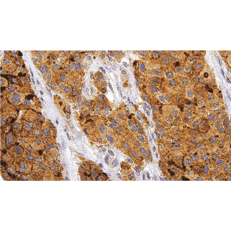 Immunohistochemistry - Anti-Glypican 3 Antibody [IHC305] (A324466) - Antibodies.com