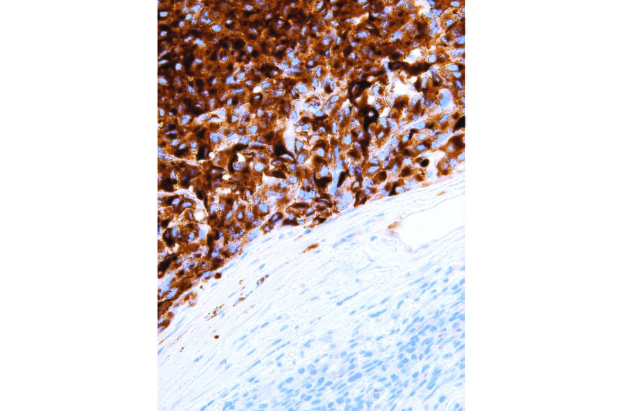 Immunohistochemistry - Anti-HMB-45 Antibody [IHC602] (A324478) - Antibodies.com