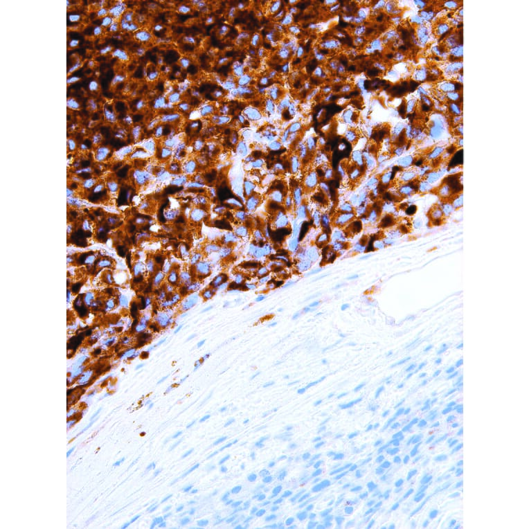 Immunohistochemistry - Anti-HMB-45 Antibody [IHC602] (A324478) - Antibodies.com