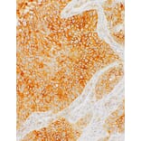 Immunohistochemistry - Anti-PD-L1 Antibody [IHC441] (A324490) - Antibodies.com