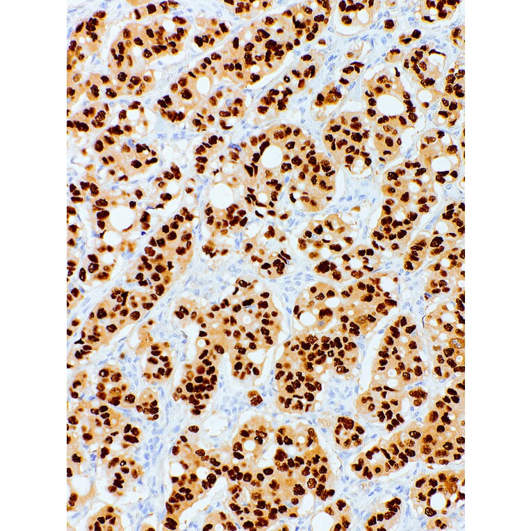 Immunohistochemistry - Anti-Progesterone Receptor Antibody [IHC751] (A324492) - Antibodies.com
