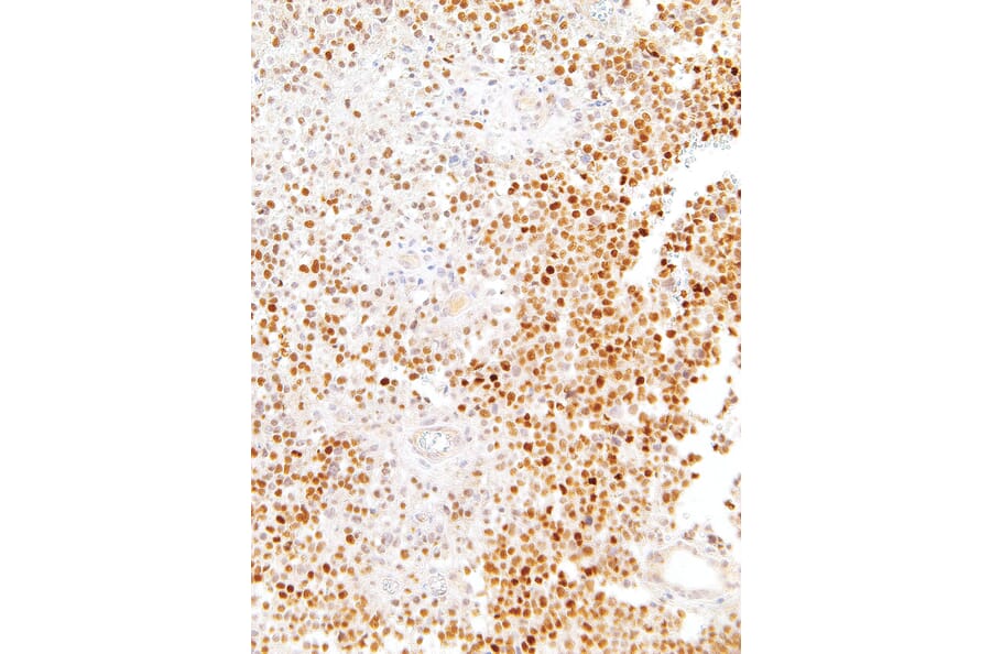 Immunohistochemistry - Anti-SOX11 Antibody [IHC111] (A324494) - Antibodies.com