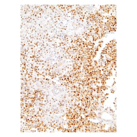 Immunohistochemistry - Anti-SOX11 Antibody [IHC111] (A324494) - Antibodies.com