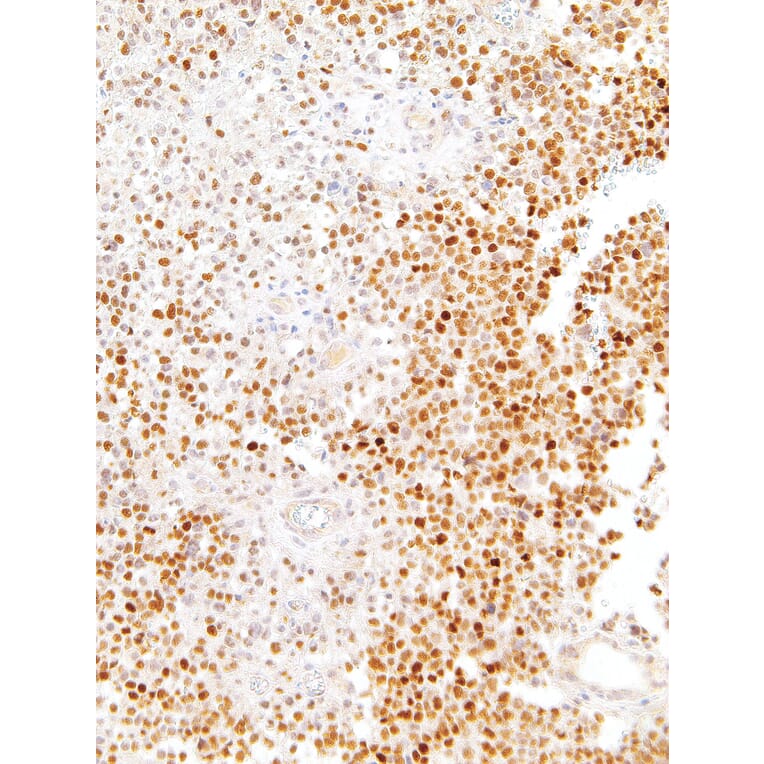 Immunohistochemistry - Anti-SOX11 Antibody [IHC111] (A324494) - Antibodies.com