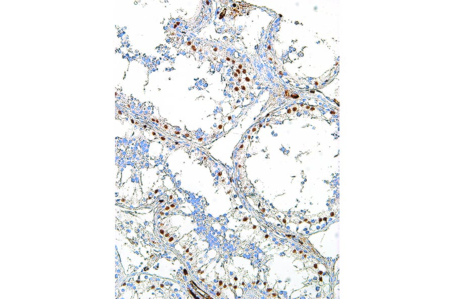 Immunohistochemistry - Anti-Wilms Tumor Protein Antibody [IHC685] (A324507) - Antibodies.com