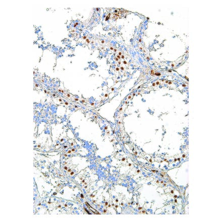 Immunohistochemistry - Anti-Wilms Tumor Protein Antibody [IHC685] (A324507) - Antibodies.com